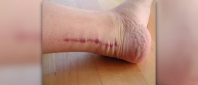 Surgery for ruptured achilles tendon