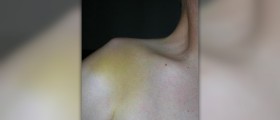 Surgery for separated shoulder