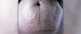 Surgery for stretch marks