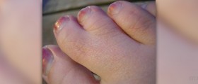 Surgery for syndactyly