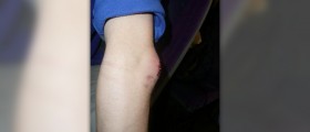 Surgery for trochanteric bursitis