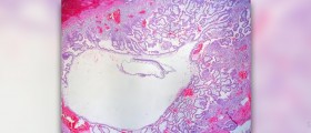 Surgery for tubal pregnancy