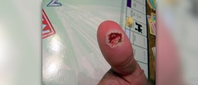 Surgery for wart removal