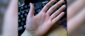 Sweaty palms cure