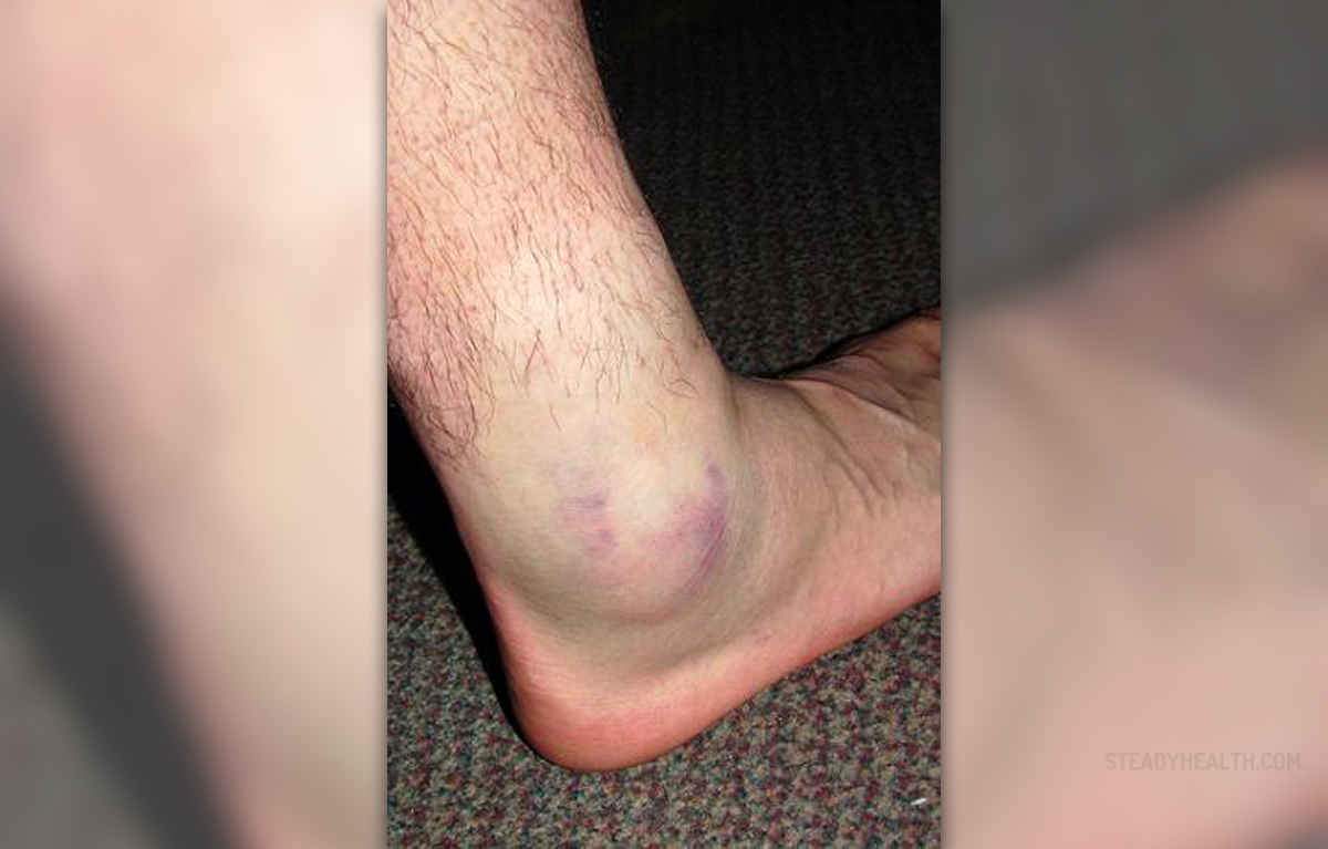 pictures-of-swollen-ankles-due-to-kidney-problems-gertywine