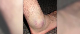 Swollen ankles fluid retention