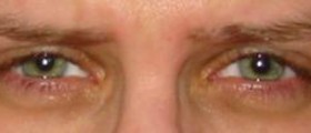 Swollen eyelid symptoms