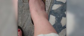Swollen feet during pregnancy
