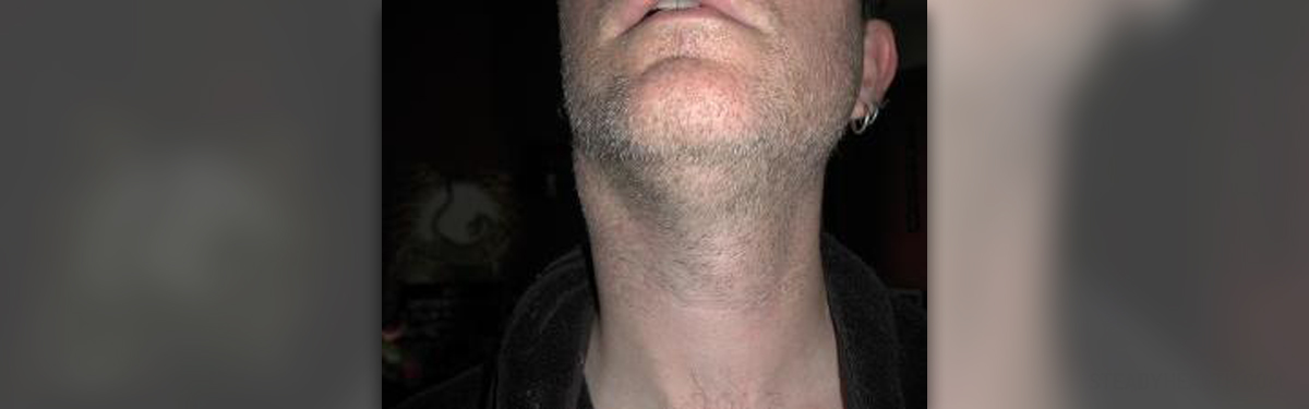 Swollen glands in neck | General center | SteadyHealth.com