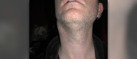 Swollen glands in neck