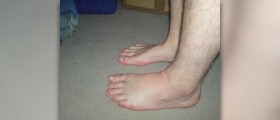 Swollen hands and feet