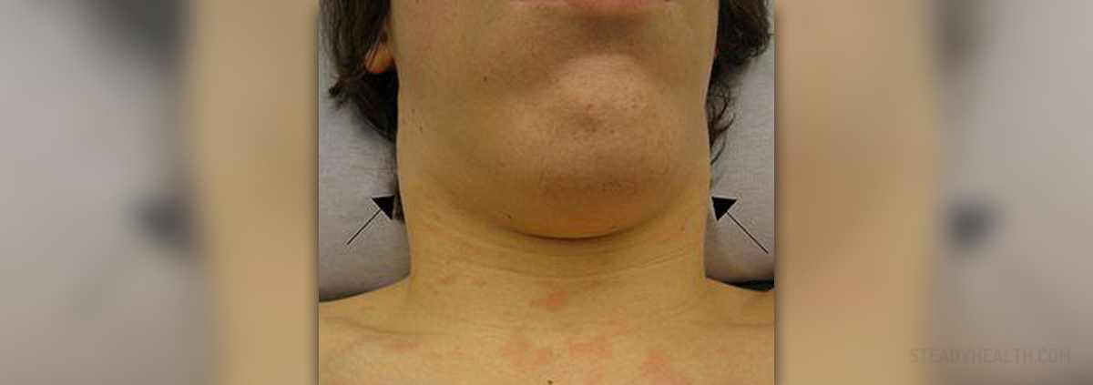Swollen lymph nodes in children | General center | SteadyHealth.com