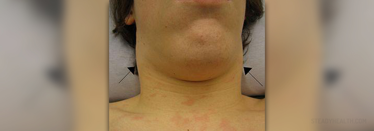 Swollen Lymph Nodes In Children General Center