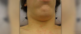 Swollen lymph nodes in children