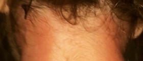 Swollen lymph nodes in neck