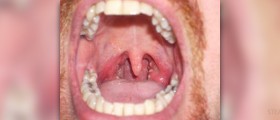Swollen sore throat