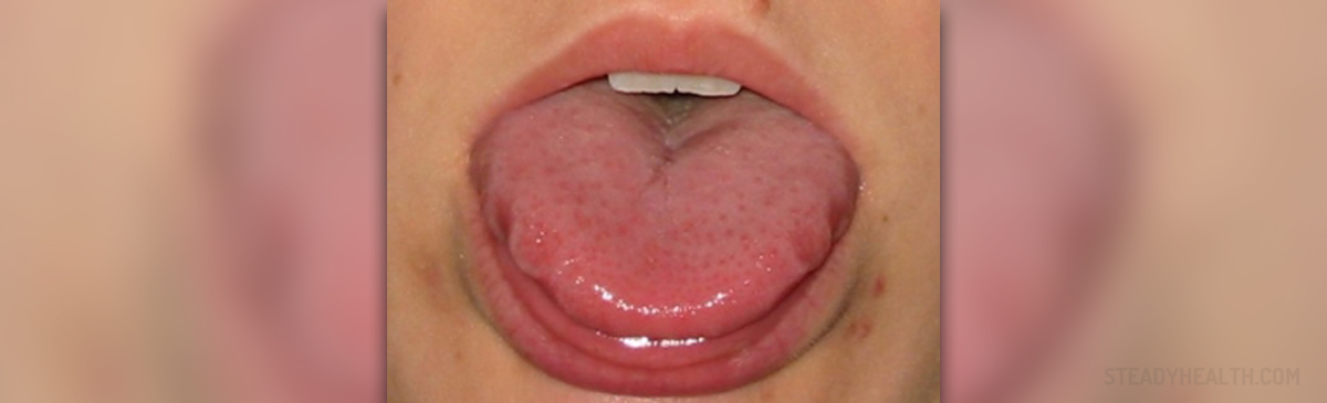 pimples-on-tongue-ear-nose-throat-and-dental-problems-articles