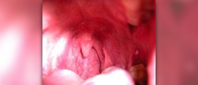 Swollen uvula causes