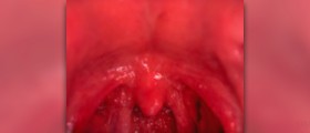 Swollen uvula remedies
