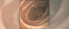 Symptoms and treatment for celiac disease