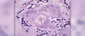 Symptoms and treatment for sarcoidosis disease