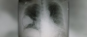 Symptoms and treatment of walking pneumonia in children