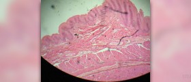 Symptoms, causes and treatments for Barrette's esophagus