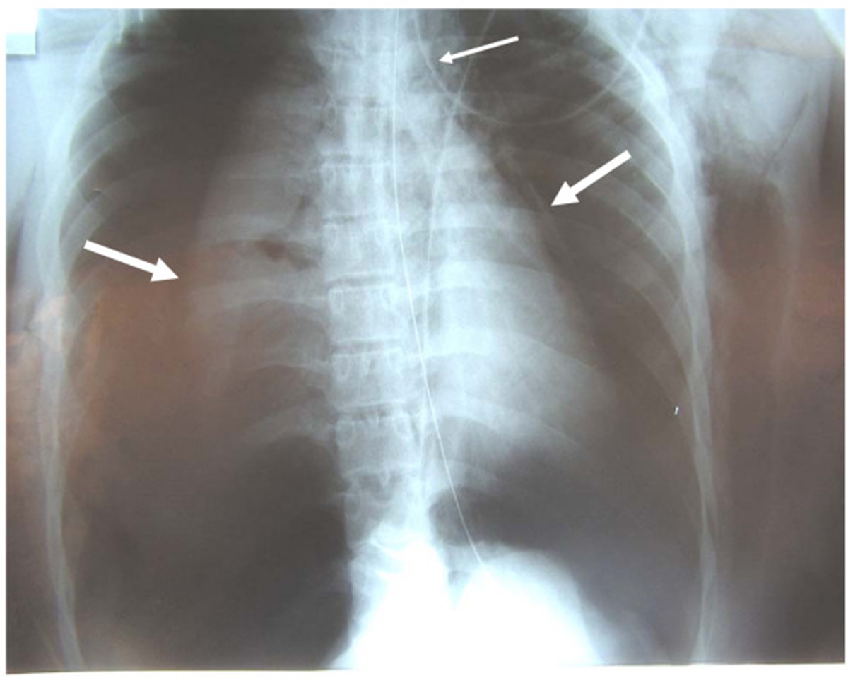 symptoms-of-a-punctured-lung-general-center-steadyhealth