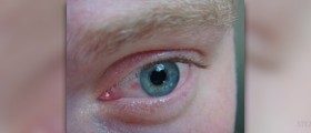 Symptoms of bloodshot eyes