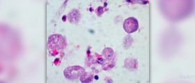 Symptoms of colitis
