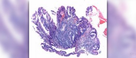 Symptoms of colon polyps