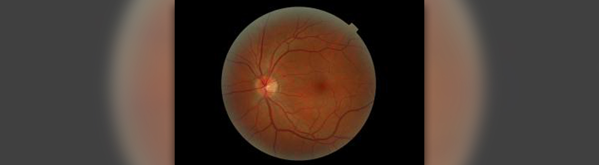 symptoms of detached retina