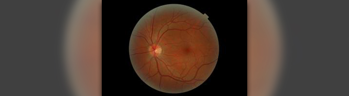 detached retina symptoms blood