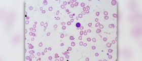 Symptoms of Fanconi Anemia