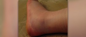 Symptoms of fractured ankle