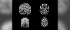 Symptoms of fungal sinusitis