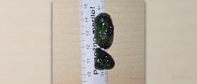 Symptoms of gallstones