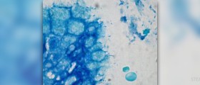 Symptoms of gastritis