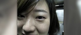 Symptoms of keratitis