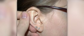 Symptoms of labyrinthitis