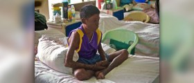 Symptoms of leprosy