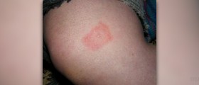 Symptoms of Lyme disease