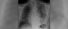 Symptoms of mesothelioma
