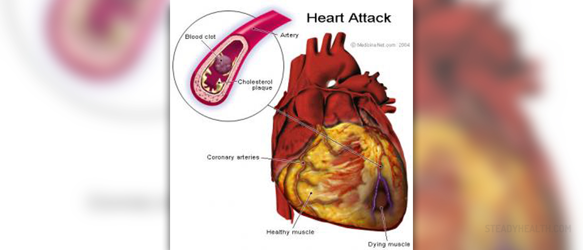 Symptoms of myocardial infarction | General center ...