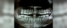 Symptoms of pyorrhea