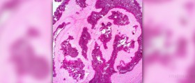 Symptoms of renal failure