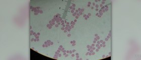 Symptoms of sickle cell anemia