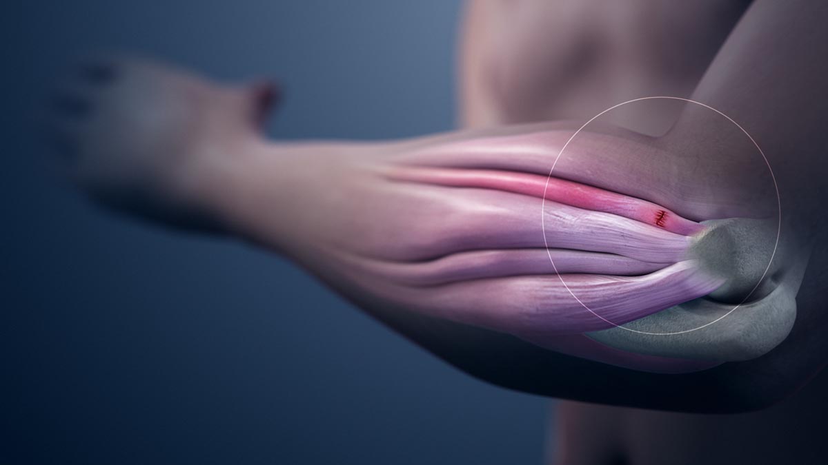 Symptoms of tendonitis | General center | SteadyHealth.com