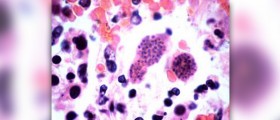 Symptoms of toxoplasmosis