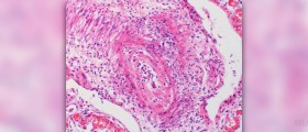 Symptoms of vasculitis